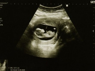 Hình ảnh Siêu âm thai nhi 12 tuần (Ảnh: arhendrix/ Shutterstock)