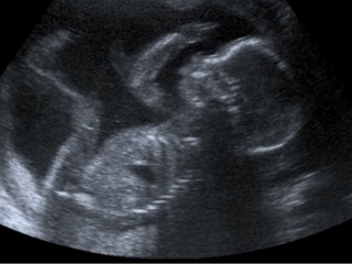 Thai nhi 20 tuần tuổi. | Nguồn ảnh: Steve qua Flickr (CC BY-NC 2.0)